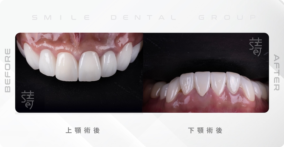 楊-150-0901-確認150全口咬合重建-07