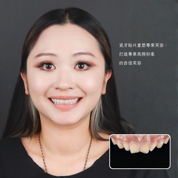 瓷牙貼片重塑專業笑容:打造專業商務形象的自信笑容