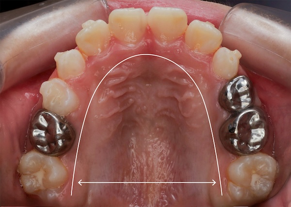 _MG_0004 蔡 上顎-01