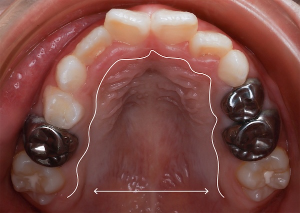 _MG_1326 蔡 上顎-02