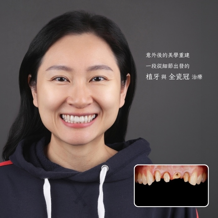 意外後的美學重建 一段從細節出發的植牙與全瓷冠治療