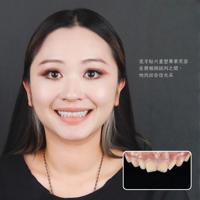 瓷牙貼片重塑專業笑容 在簡報與談判之間， 她找回自信光采