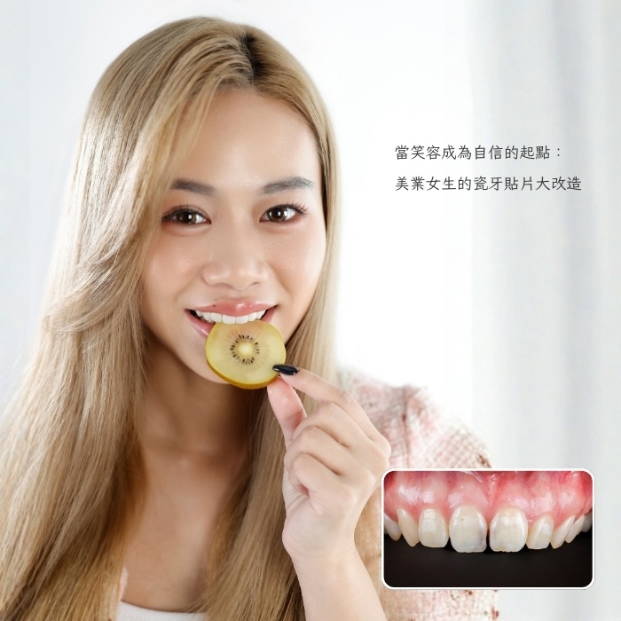 當笑容成為自信的起點：美業女生的瓷牙貼片大改造