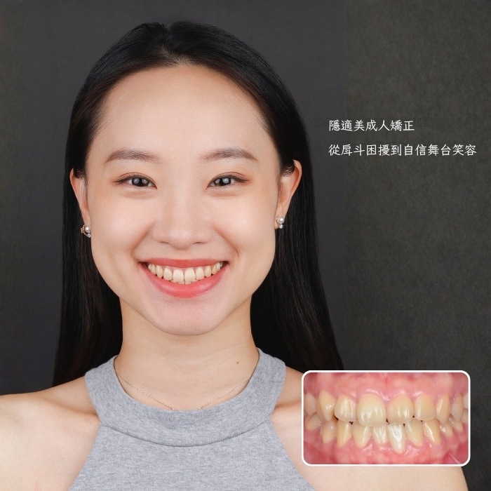 隱適美成人矯正｜從戽斗困擾到自信舞台笑容