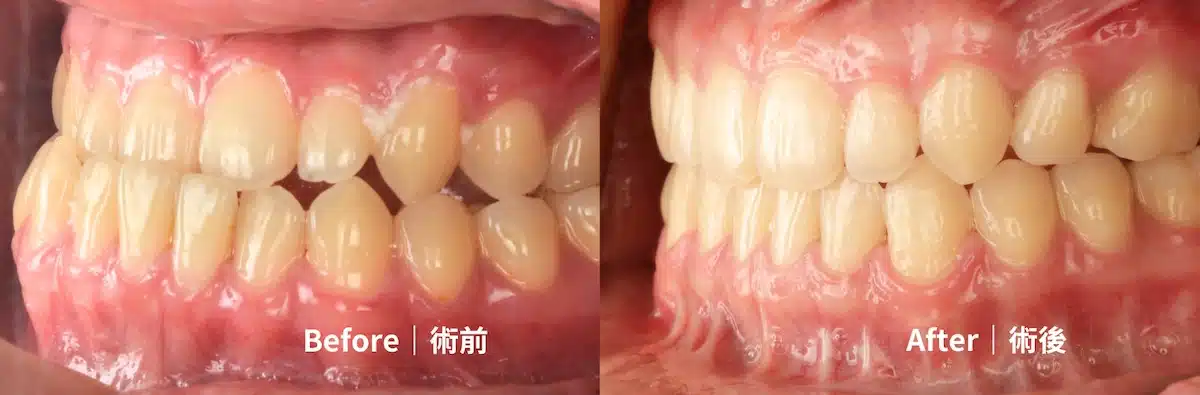 隱適美頁面患者BA半臉照版型-葉-2