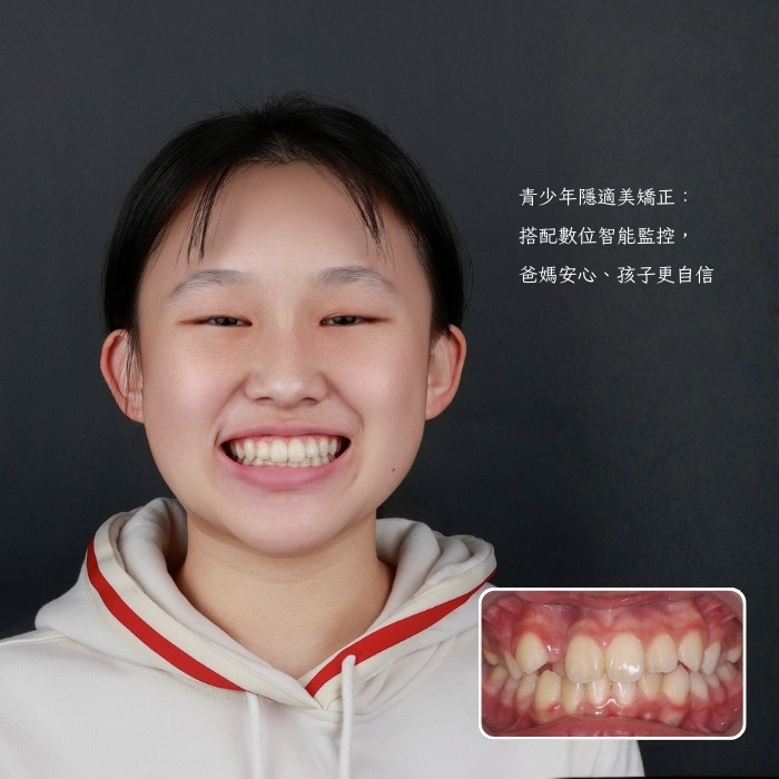 青少年隱適美矯正：搭配數位智能監控，爸媽安心、孩子更自信