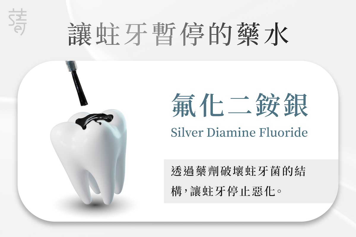 兒童救蛀牙的 黑色醬汁 銀氨氟化物