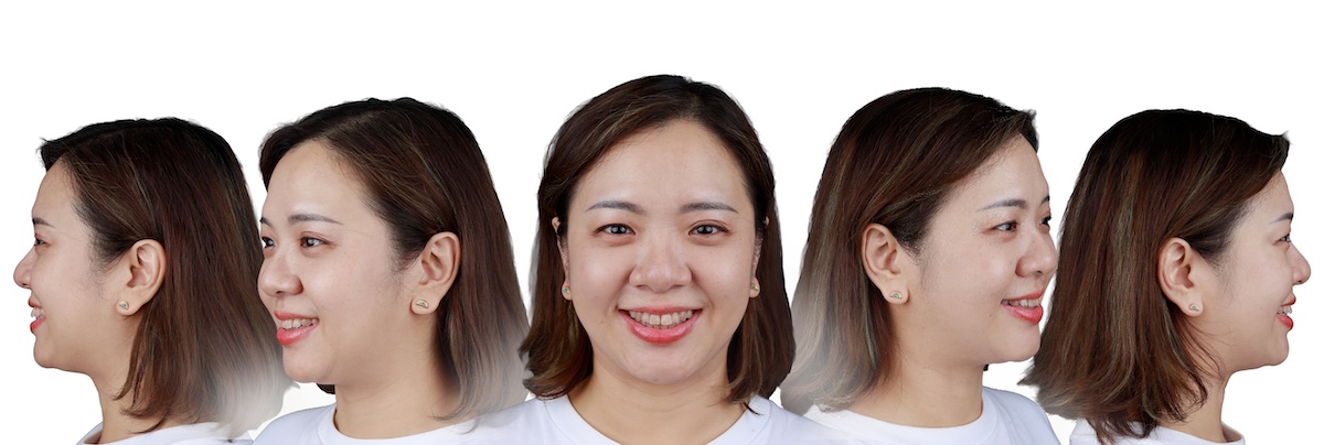 楊-術前 五面圖