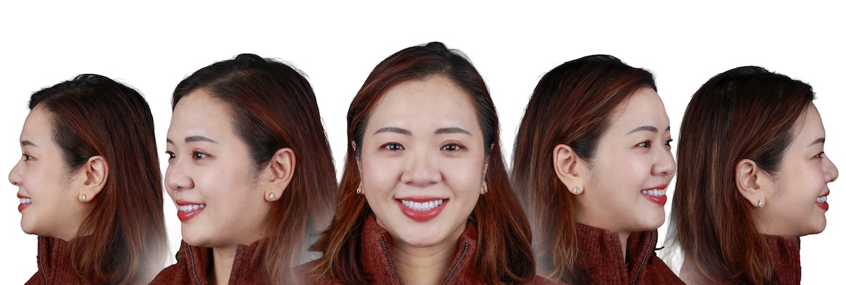 楊-術後 五面圖