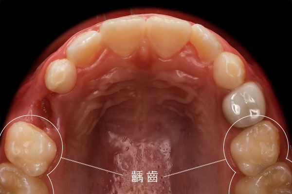 米果 術前a_MG_3807