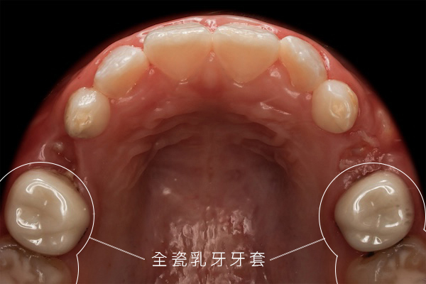 米果a 術後a_MG_5111