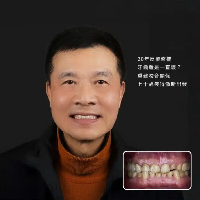 20年反覆修補，牙齒還是一直壞？ 重建咬合關係，七十歲笑得像新出發