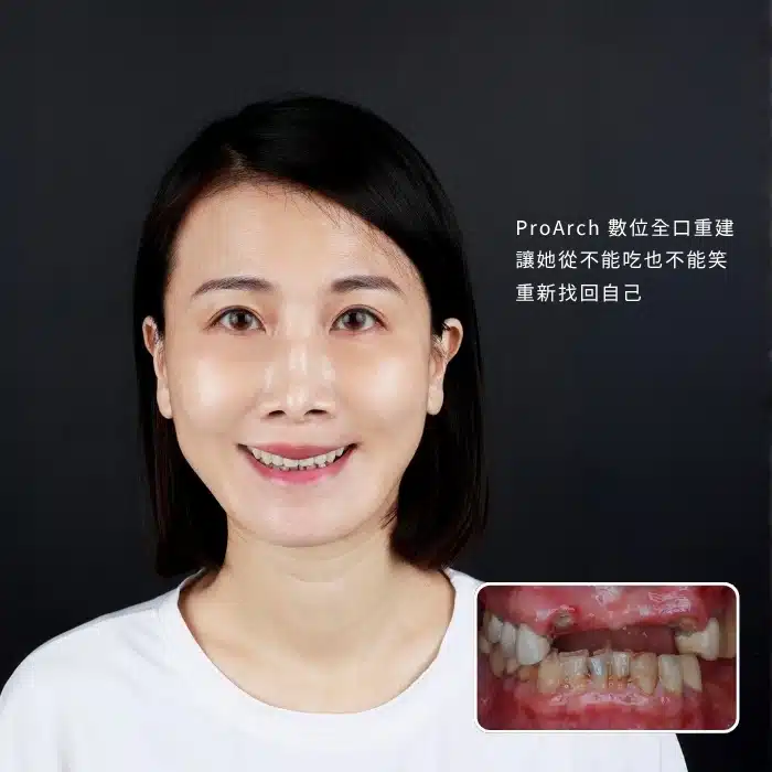 ProArch 數位全口重建，讓她從不能吃也不能笑，重新找回自己