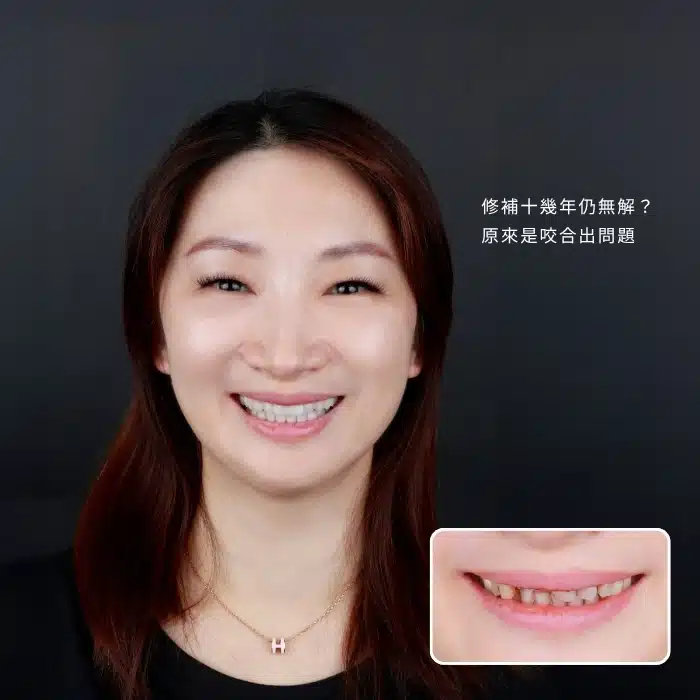 修補十幾年仍無解？原來是咬合出問題