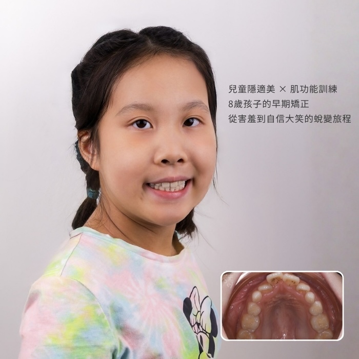 兒童隱適美 × 肌功能訓練：8歲孩子的早期矯正，從害羞到自信大笑的蛻變旅程