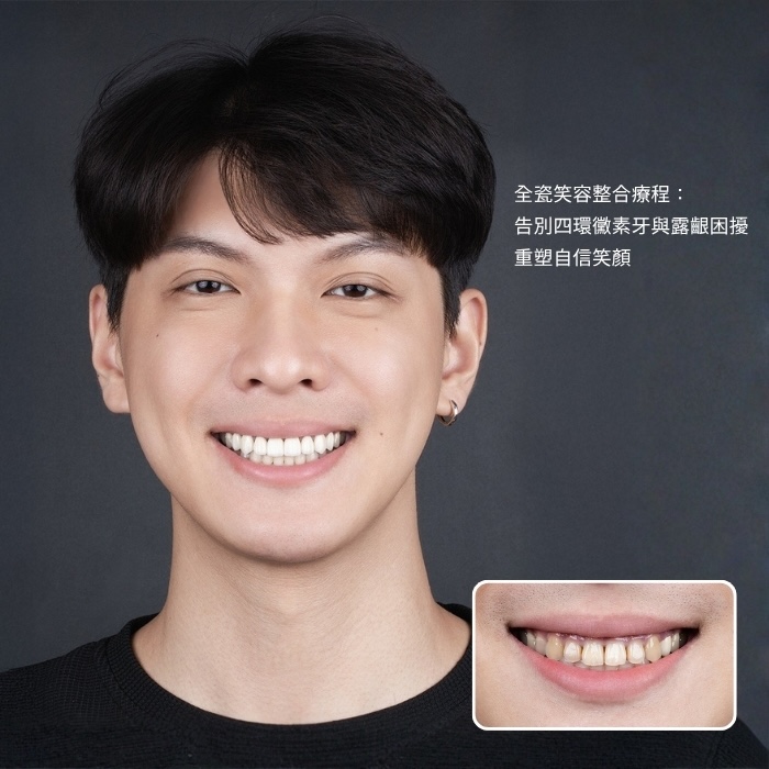 全瓷笑容整合療程：告別四環黴素牙與露齦困擾，重塑自信笑顏