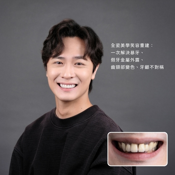 全瓷美學笑容重建，一次解決暴牙、假牙金屬外露、齒頸部變色、牙齦不對稱