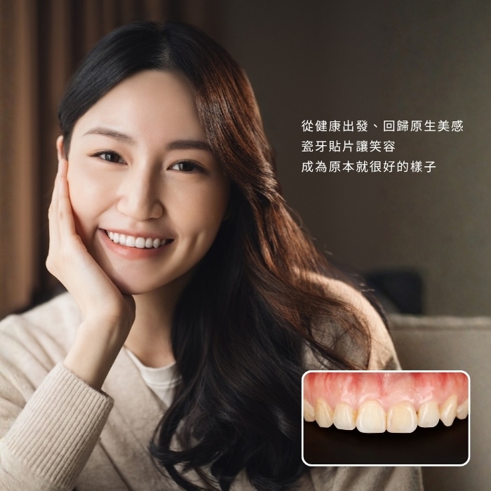 從健康出發、回歸原生美感 瓷牙貼片讓笑容 成為原本就很好的樣子