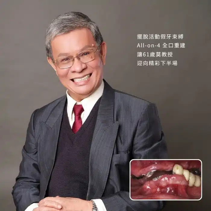擺脫活動假牙束縛，All-on-4 全口重建，讓61歲莫教授迎向精彩下半場