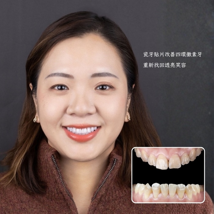 瓷牙貼片改善四環黴素牙｜重新找回透亮笑容