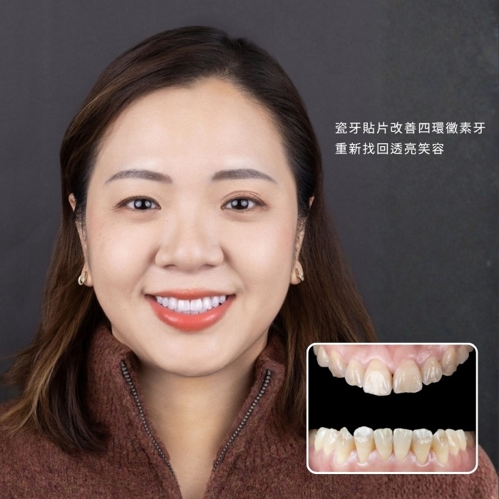 瓷牙貼片改善四環黴素牙｜重新找回透亮笑容