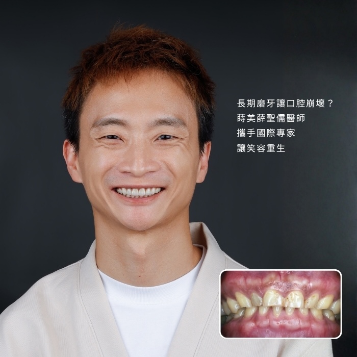 長期磨牙讓口腔崩壞？蒔美薛聖儒醫師攜手國際專家，讓笑容重生