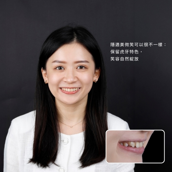 隱適美微笑可以很不一樣：保留虎牙特色，笑容自然綻放