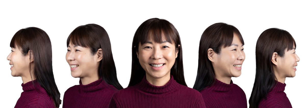 王小姐術後 五面圖