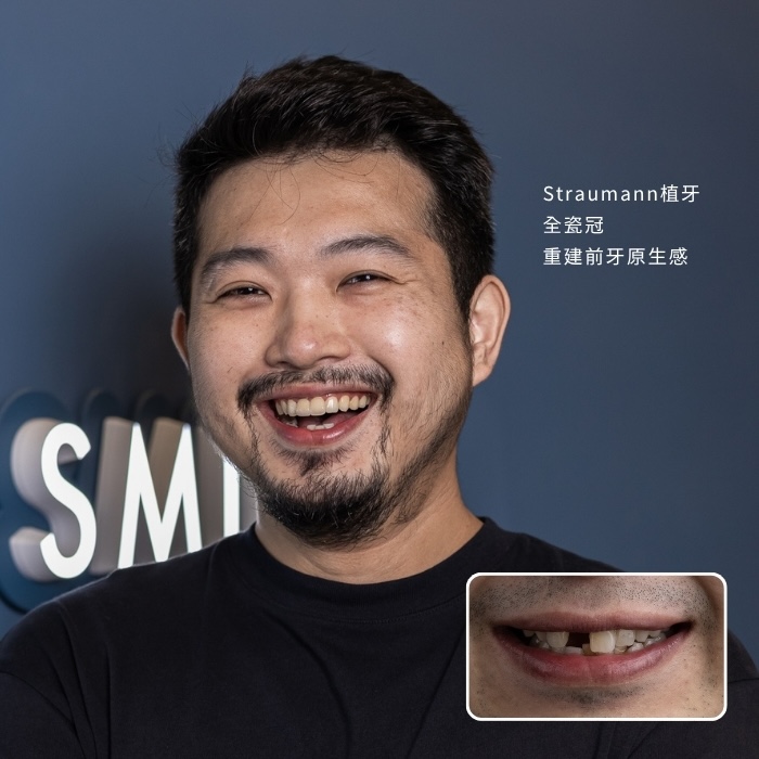 Straumann植牙加全瓷冠，重建前牙原生感