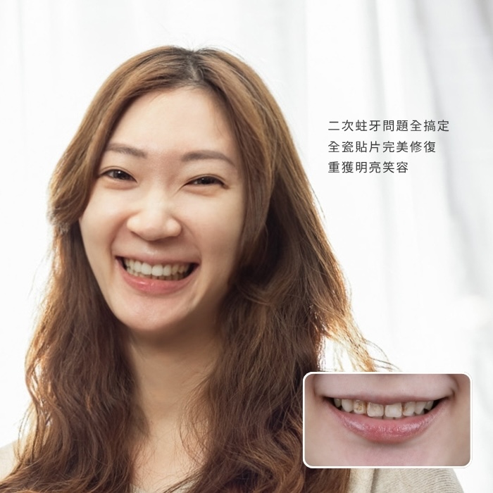 二次蛀牙問題全搞定，全瓷貼片完美修復，重獲明亮笑容！