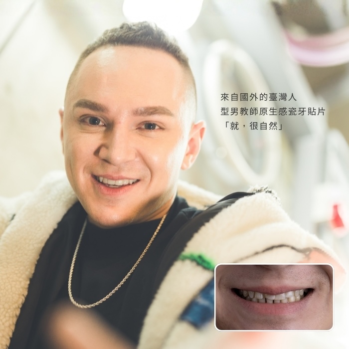 來自國外的臺灣人，型男教師原生感瓷牙貼片「就，很自然」