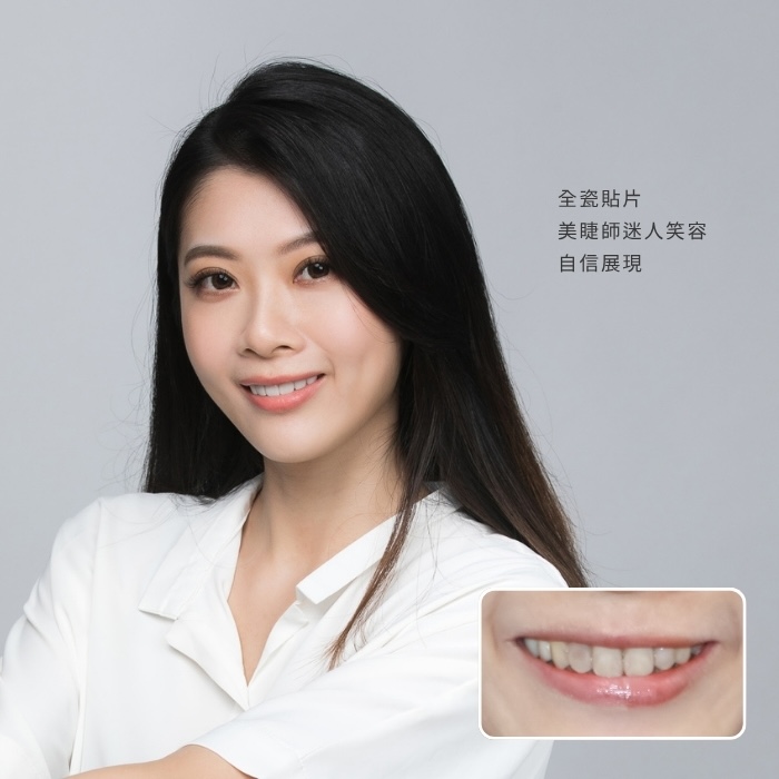全瓷貼片 美睫師迷人笑容自信展現