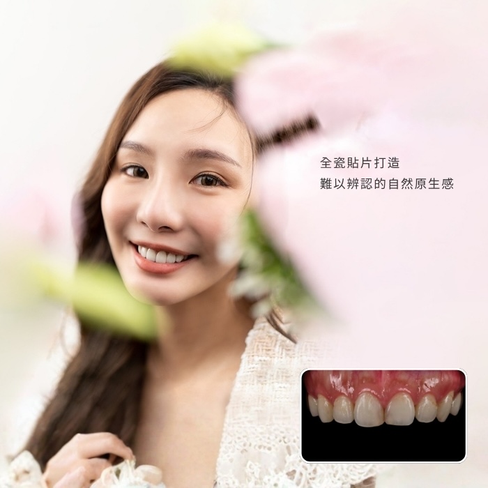 全瓷貼片打造難以辨認的自然原生感