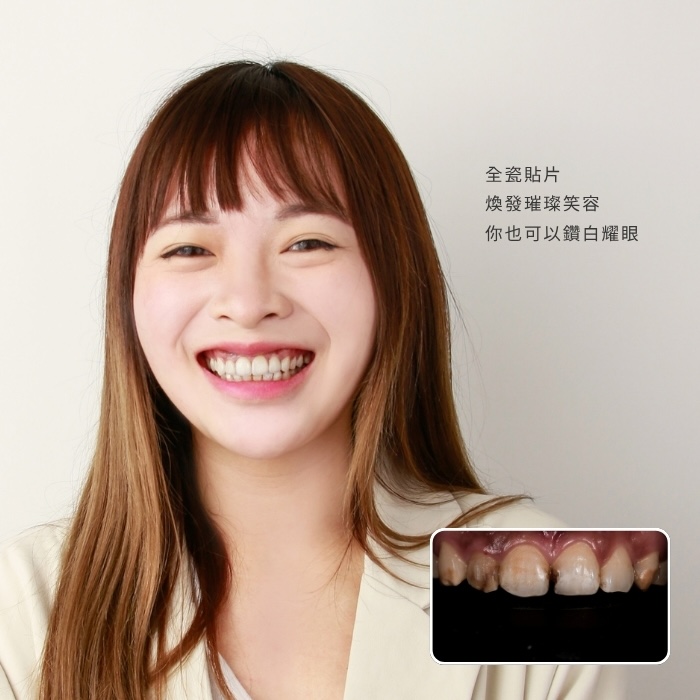 全瓷貼片煥發璀璨笑容，你也可以鑽白耀眼！