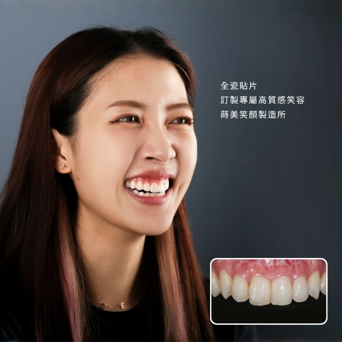 全瓷貼片訂製專屬高質感笑容：蒔美笑顏製造所