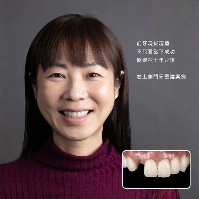 前牙現拔現植，不只看當下成功，關鍵在十年之後 —— 王小姐右上側門牙重建案例