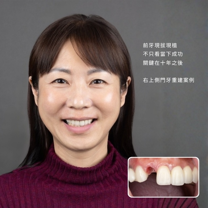 前牙現拔現植，不只看當下成功，關鍵在十年之後 —— 王小姐右上側門牙重建案例