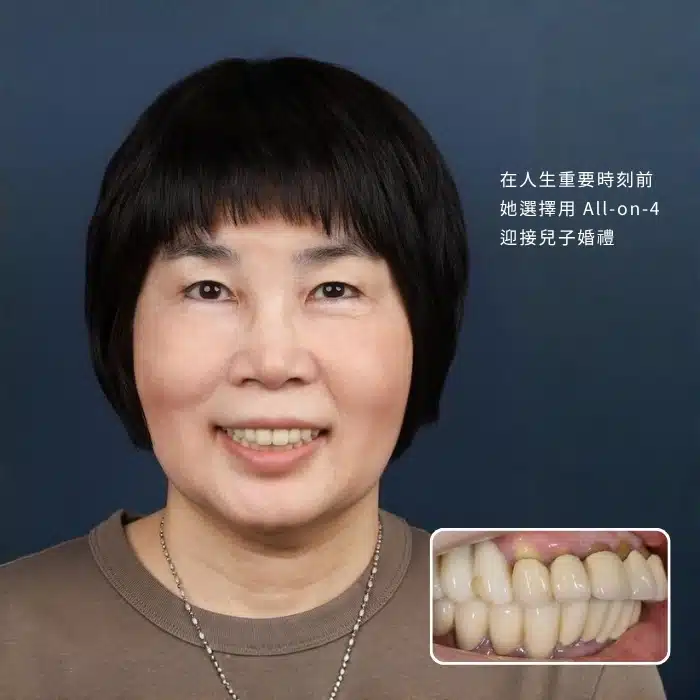 在人生重要時刻前，她選擇用 All-on-4 迎接兒子婚禮