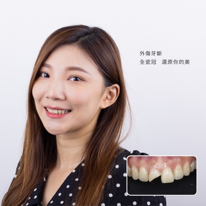 外傷牙斷「全瓷冠」還原你的美