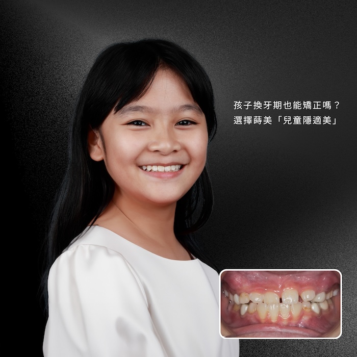 孩子換牙期也能矯正嗎？選擇蒔美「兒童隱適美」