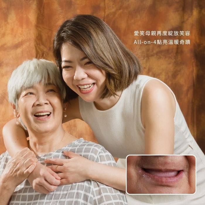 愛笑母親再度綻放笑容！All-on-4點亮溫暖奇蹟！