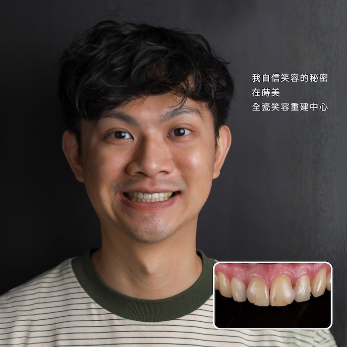 我自信笑容的秘密，在蒔美全瓷笑容重建中心