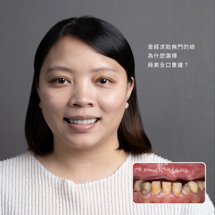 曾經求助無門的她，為什麼選擇蒔美全口重建？