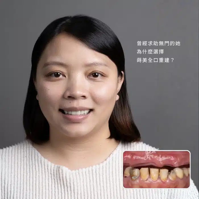 曾經求助無門的她，為什麼選擇蒔美全口重建？