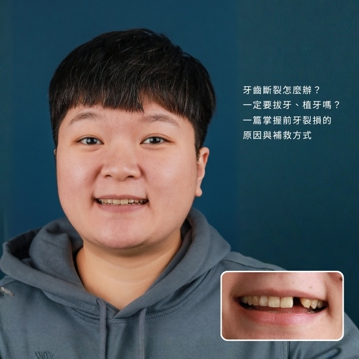 牙齒斷裂怎麼辦？一定要拔牙、植牙嗎？ 一篇掌握前牙裂損的原因與補救方式
