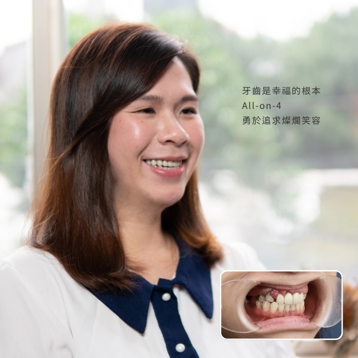牙齒是幸福的根本 All-on-4 勇於追求燦爛笑容