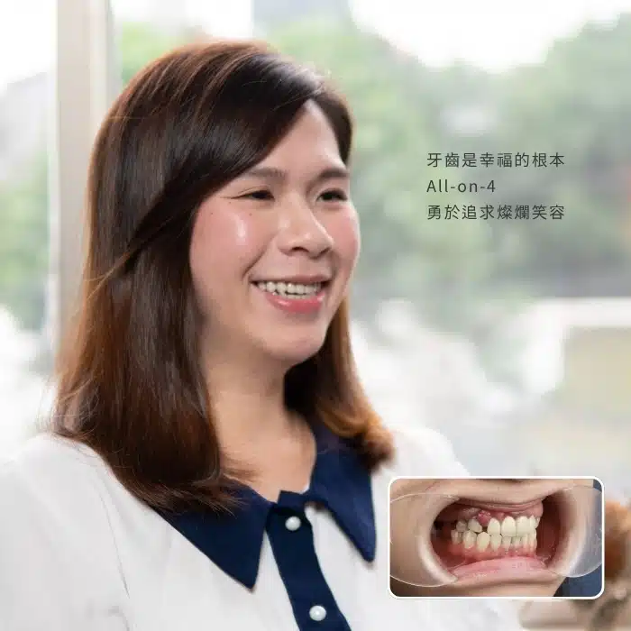 牙齒是幸福的根本 All-on-4 勇於追求燦爛笑容