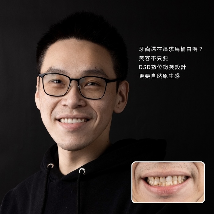 牙齒還在追求馬桶白嗎？笑容不只要DSD數位微笑設計，更要自然原生感