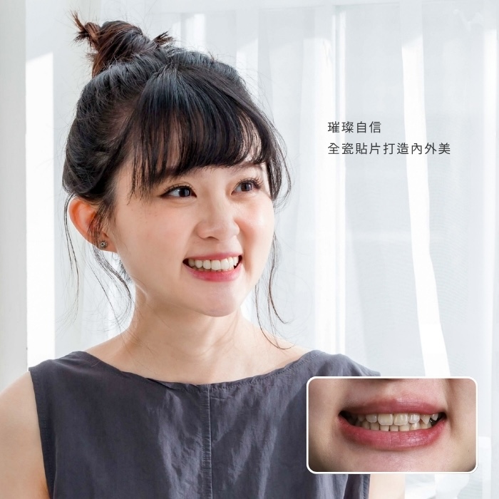 璀璨自信，全瓷貼片打造內外美