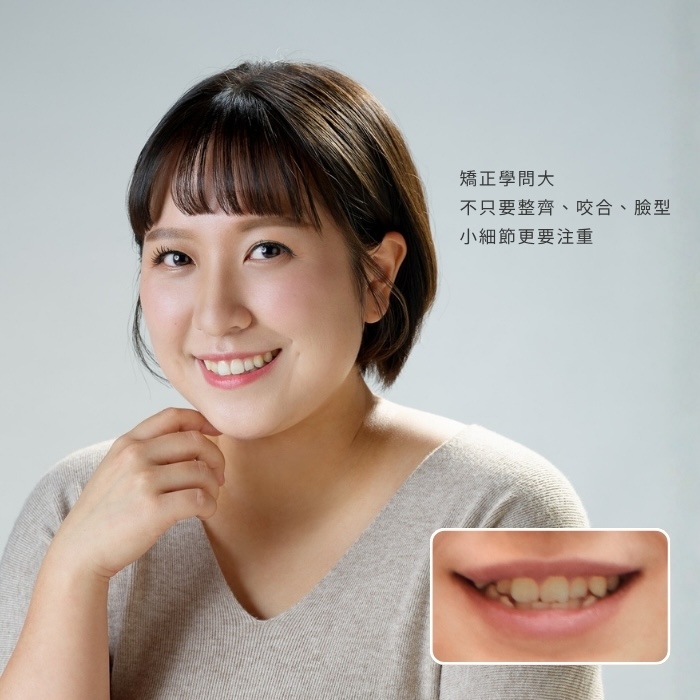 矯正學問大！不只要整齊、咬合、臉型，小細節更要注重｜板橋矯正素人案例｜蒔美牙醫